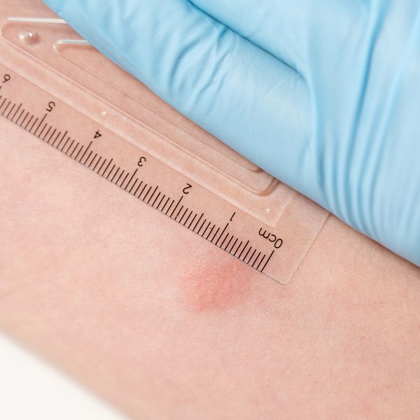 TB Skin Test & Treatment