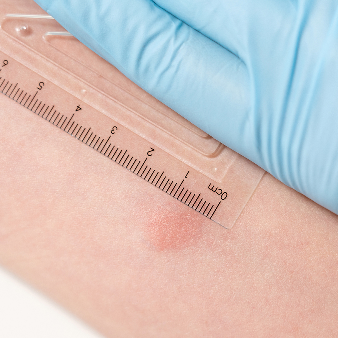 Tb Skin Test Induration Vs Swelling